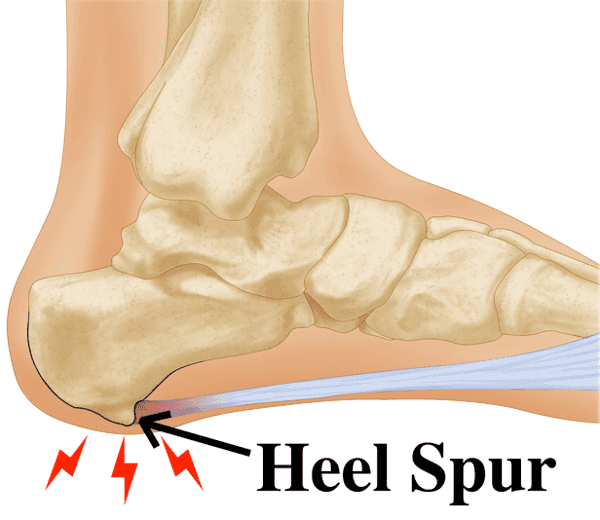 Bone Spurs — Root Cause of and Symptoms