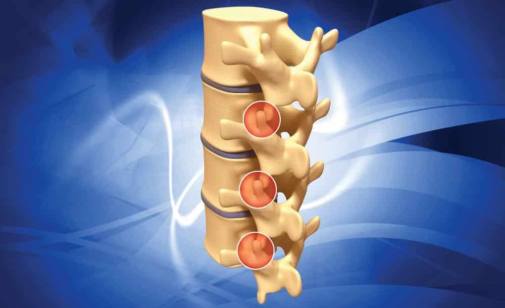 Facet Joint Syndrome — Anatomy, Signs & Symptoms