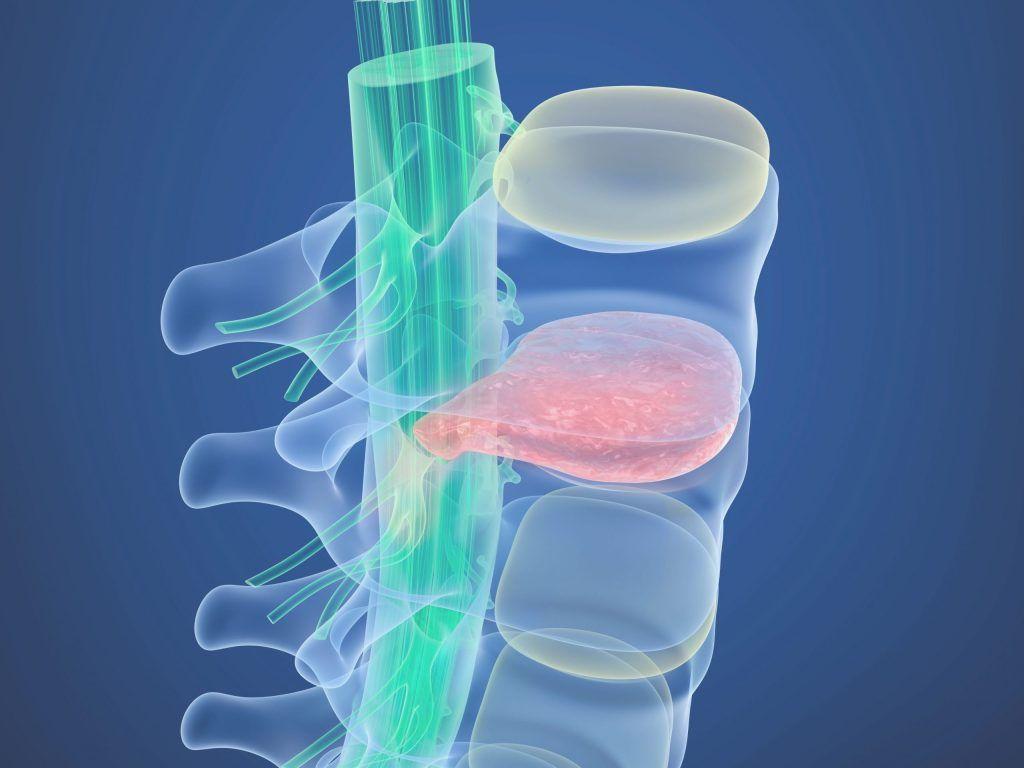 Herniated Disc Surgery, When is it the Right Procedure?