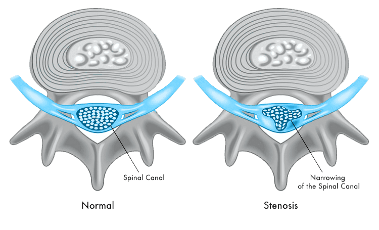 Foraminal Stenosis — What is It?