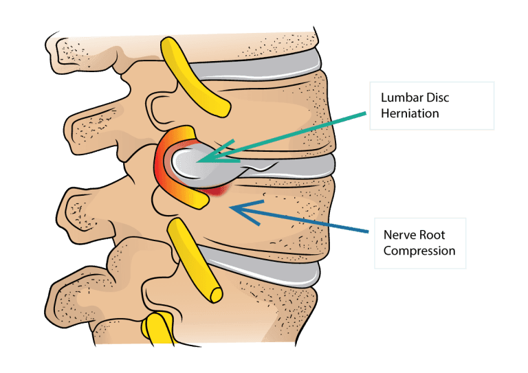 Herniated Disc Symptoms