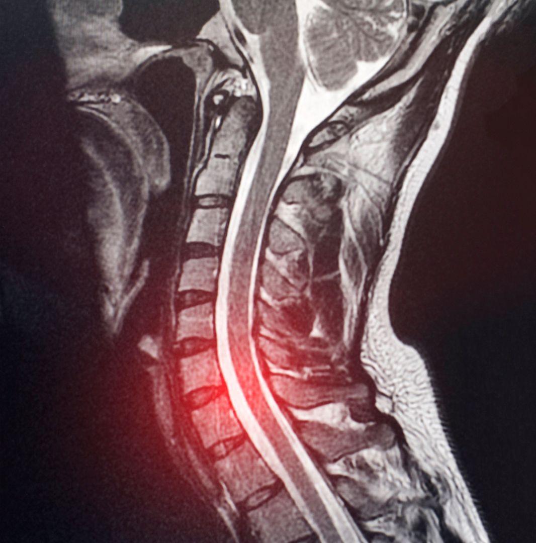 C6-C7 Disc Herniation: Treatment, Causes, & Surgery