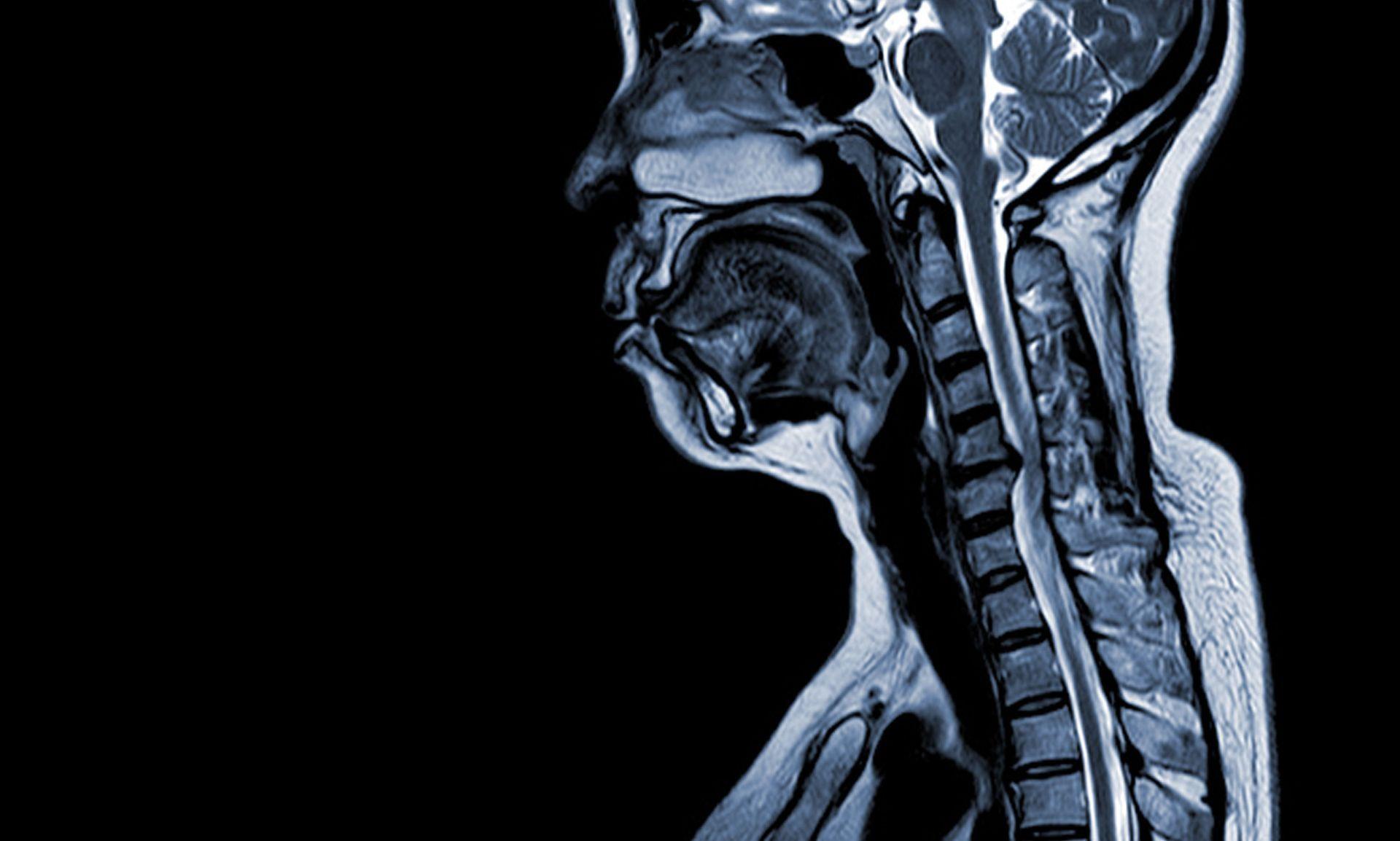 C5-C6 Disc Herniation