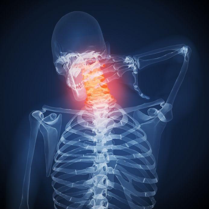 C4-C5 Disc Herniation